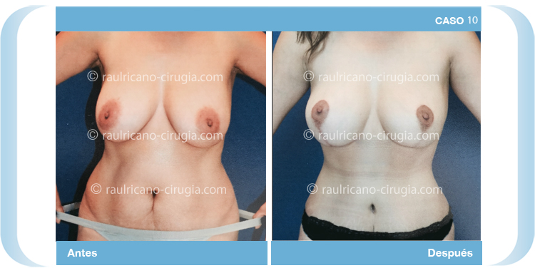 C10 Abdominoplastia con liposucción más levantamiento mamario Raúl Ricaño Rueda Cirujano Plástico Certificado Puebla México