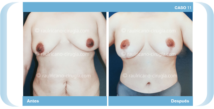 C11 Abdominoplastia con liposucción y levantamiento mamario Raúl Ricaño Rueda Cirujanos Plásticos Certificados Puebla México