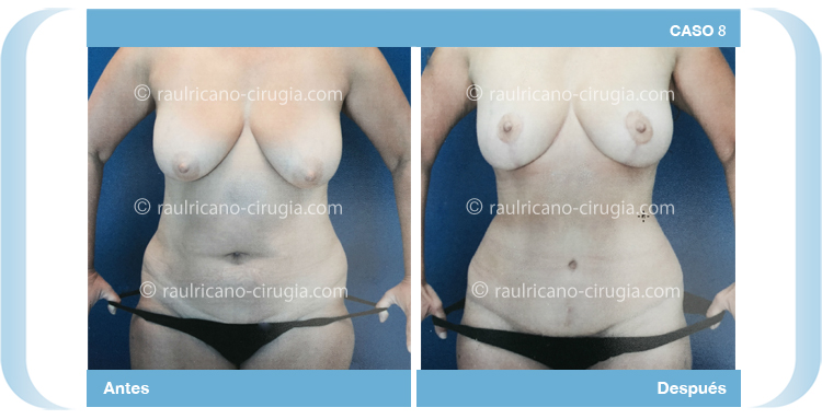 C8 Abdominoplastia con liposucción y levantamiento mamario  Raúl Ricaño Rueda miembro internacional de la ASPS American Society of Plastic Surgeons